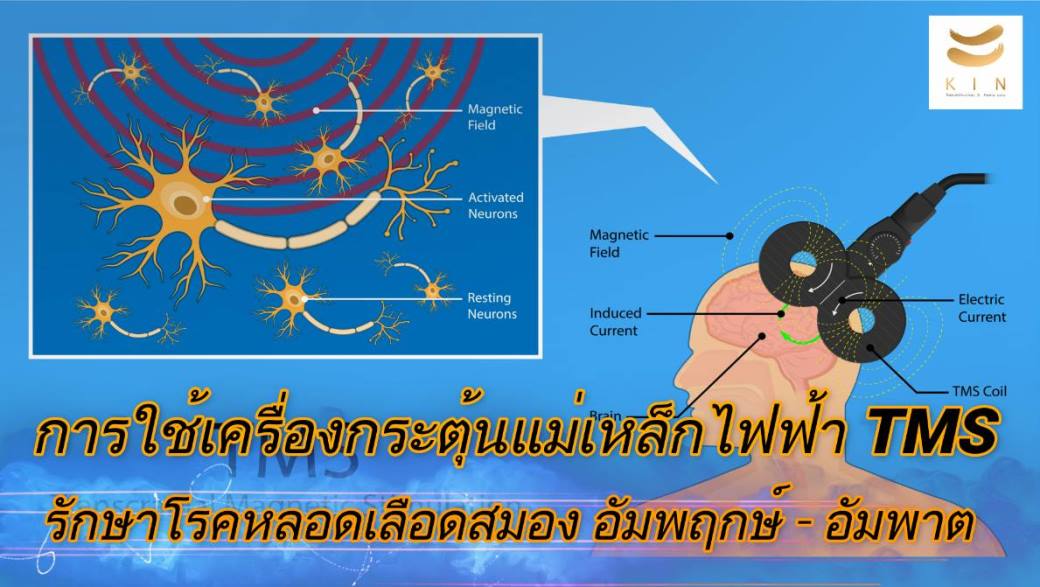 การใช้เครื่องกระตุ้นแม่เหล็กไฟฟ้า TMS รักษาโรคหลอดเลือดสมอง อัมพฤษ์ อัมพาต