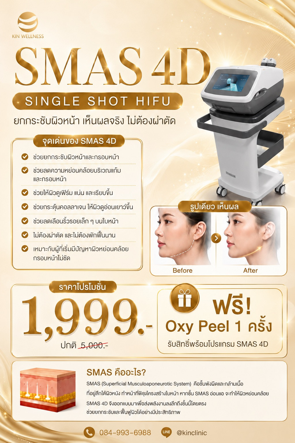 โปรแกรมยกกระชับด้วยพลังงานเสียงความเข้มข้นสูง (HIFU) ราคาเริ่มต้น 1,990 บาท