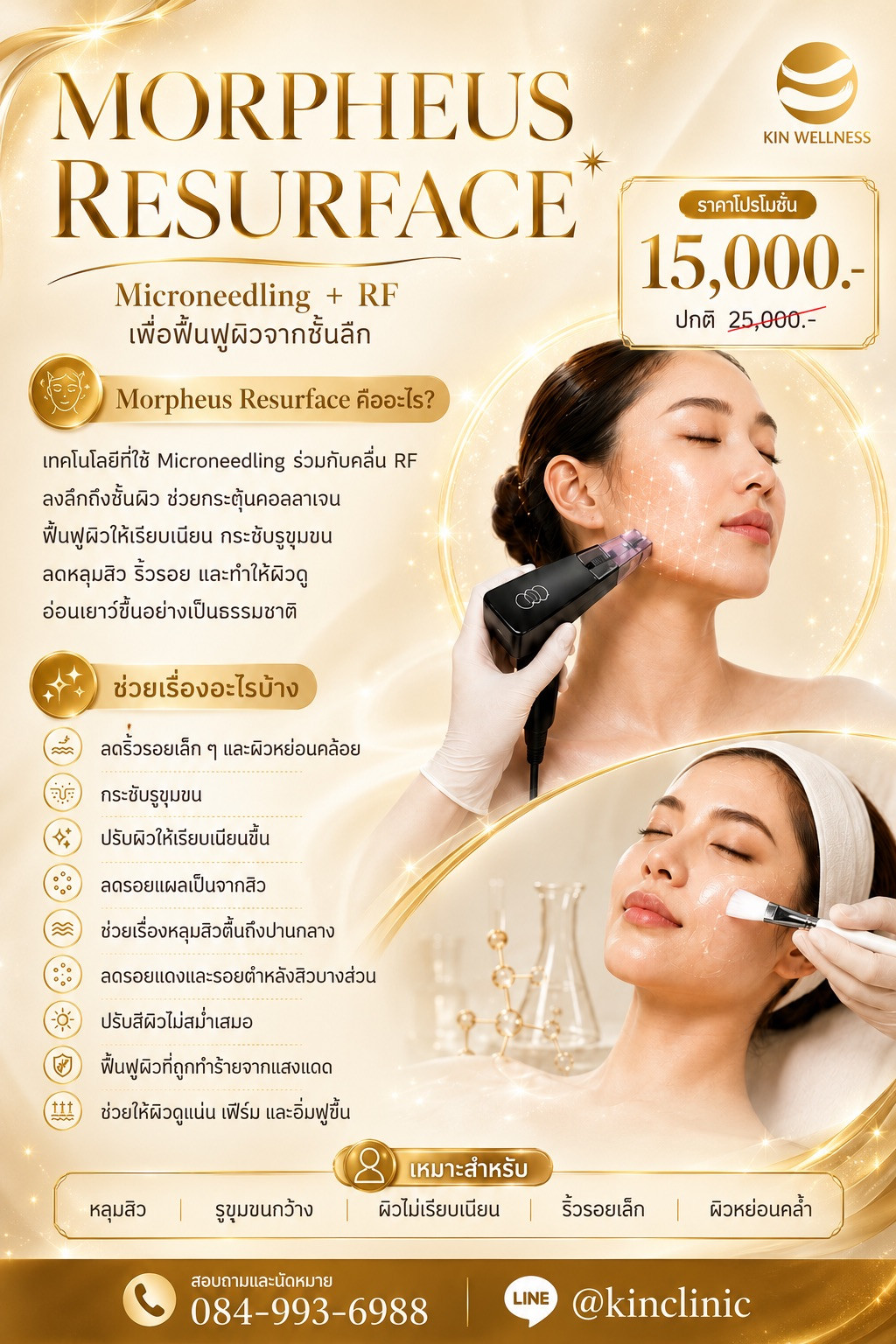 Morpheus8 โปรแกรมยกกระชับระดับลึก ที่ช่วยทวงคืนความอ่อนเยาว์ให้ผิวคุณ ราคา 15,000 บาท